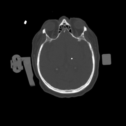 1.25mm-Deep Brain-Stimulation-Bone-Window-1-Electrode